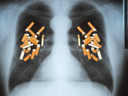 Thuốc lá chính là kẻ thù của lá phổi và cơ thể bạn